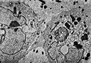 F,16y. | bone marrow -malignant histiocytosis F,16y. | bone marrow -malignant histiocytosis